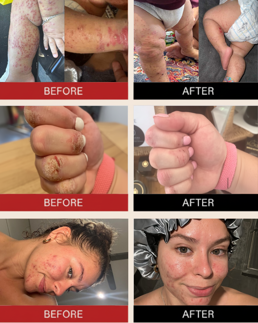 Complete Psoriasis Care Pack / ALOE ACTIVE